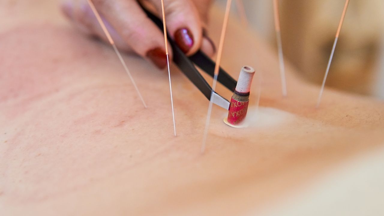 Acupuntura quais os benefícios