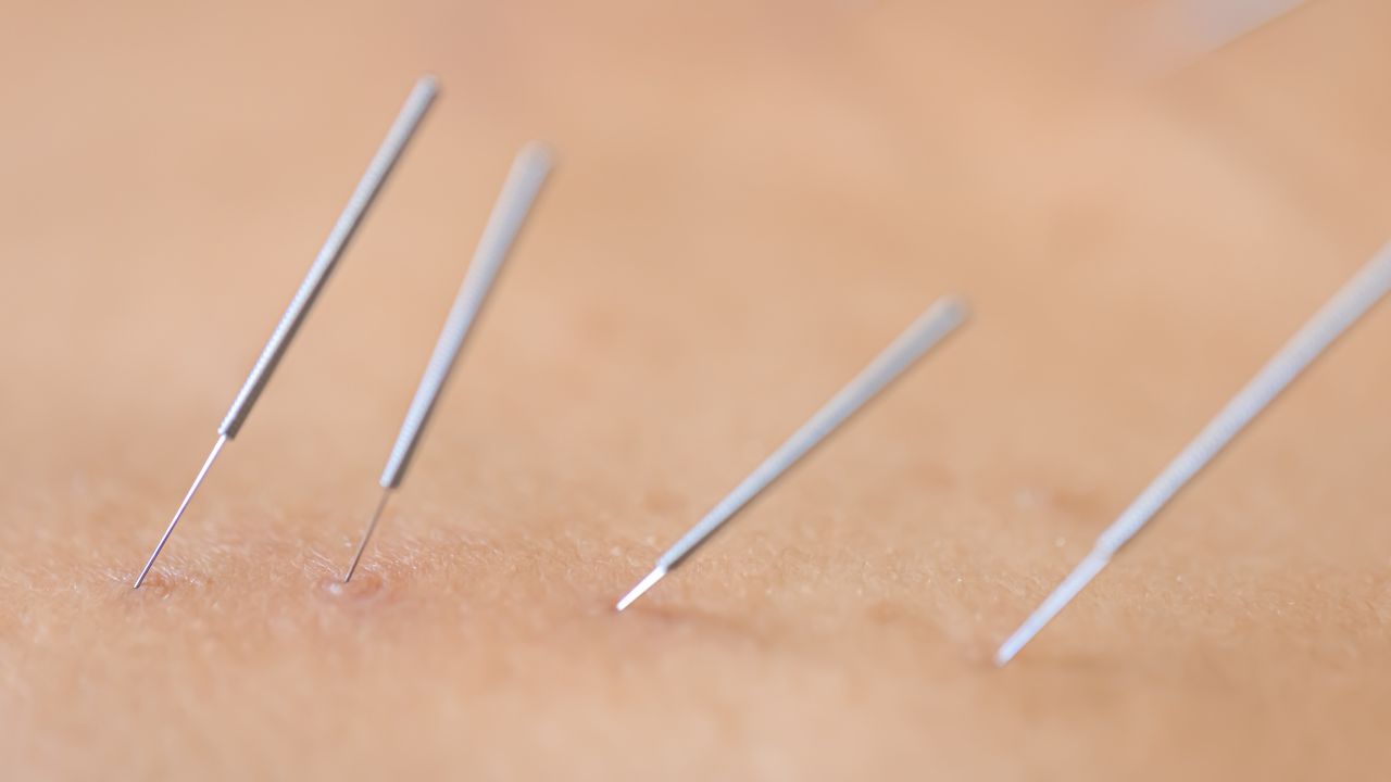 acupuntura para que serve