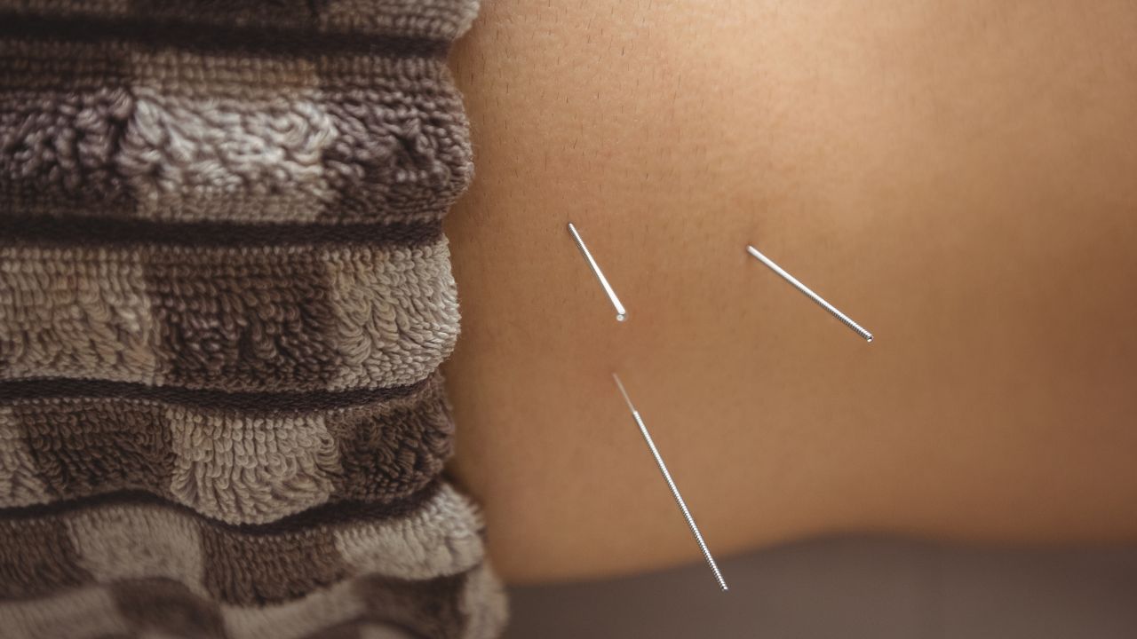 Quanto custa uma sessão de acupuntura