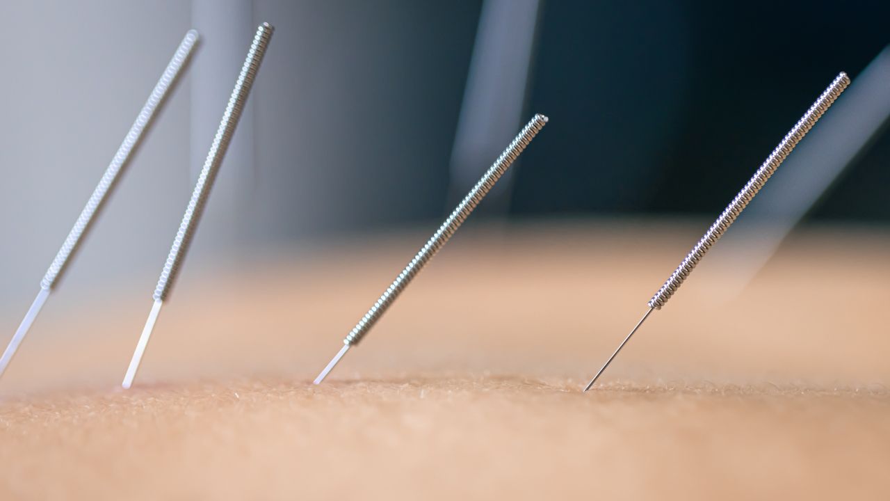 o que é acupuntura
