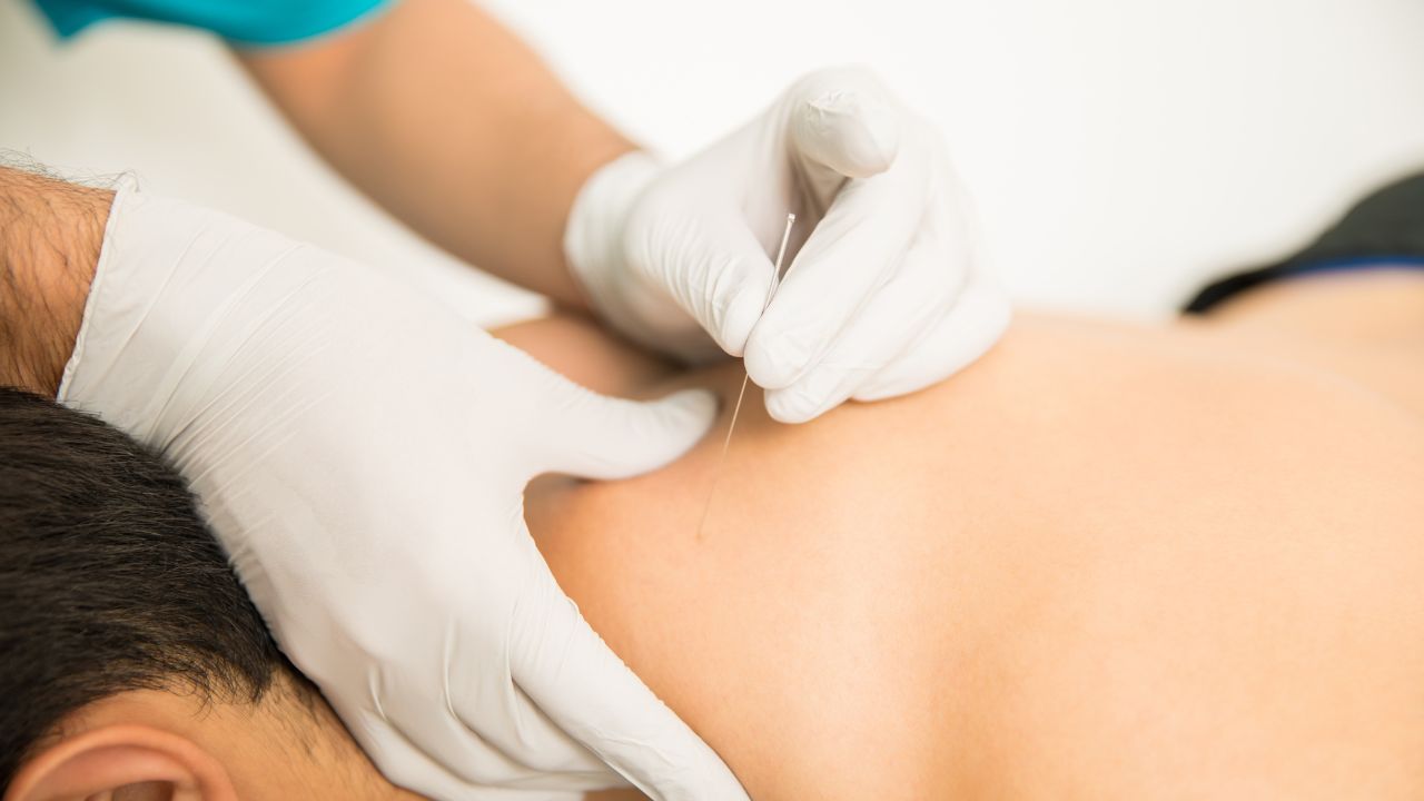 para que serve a acupuntura
